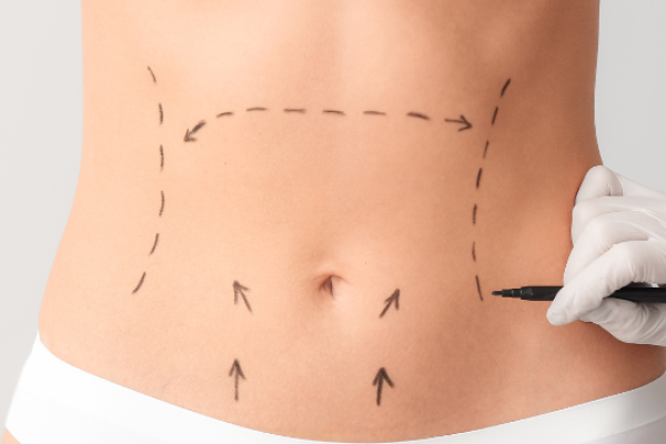 abdominoplastia